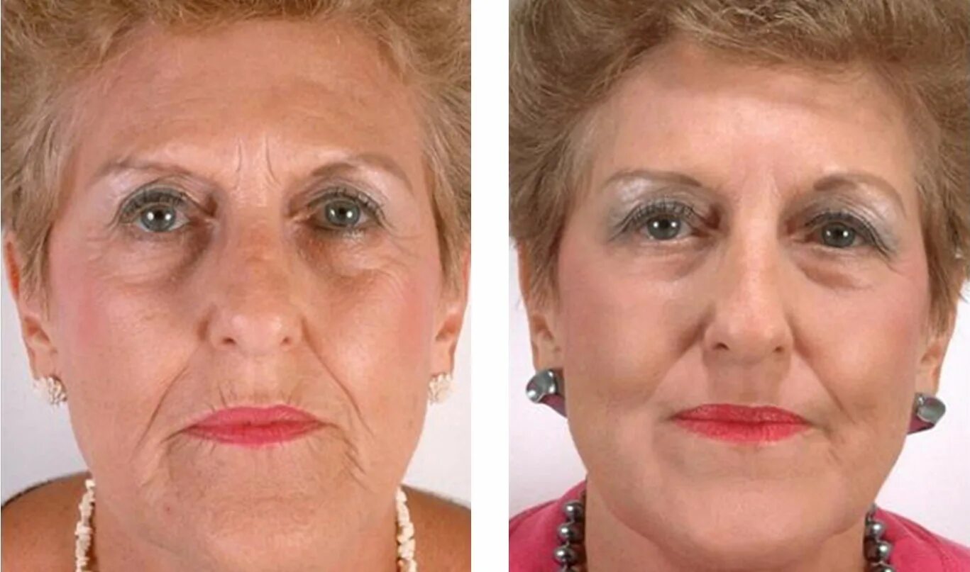 Антивозрастная кожа. Процедуры омоложения после 40. Массаж лица у косметолога. Крем для омоложения кожи лица. Женщина с морщинами.