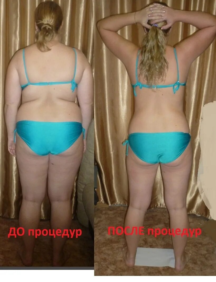 Липолитики целлюлит до после. Если похудеть целлюлит уйдет. Эффект после обертывания. Руки до и после похудения. Липодистрофия целлюлит.