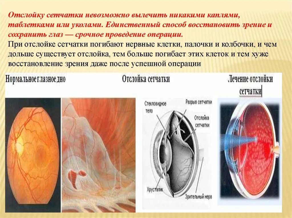 Регматогенная отслойка сетчатки глаза. Регматогенная отслойка сетчатки симптомы. Отслойка сетчатки этиология клиника. Отслойка сетчатки этиопатогенеза.