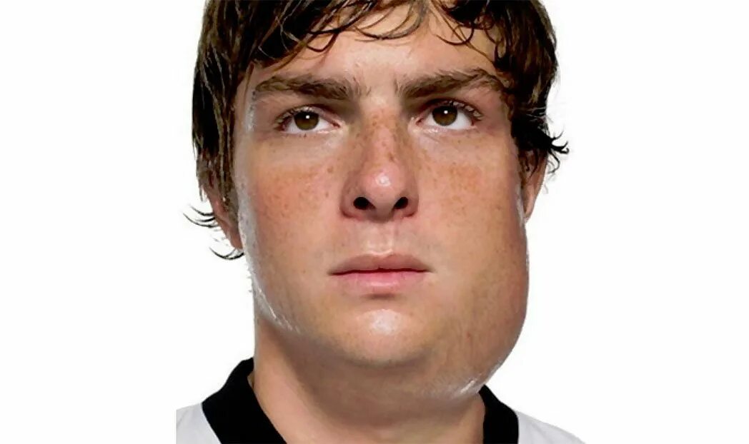 Эпидемический паротит свинка болезнь. Эпидпаротит. Эпидемический паротит периоды заболевания. Эпидермальный паротит. Эпидемический паротит передача.