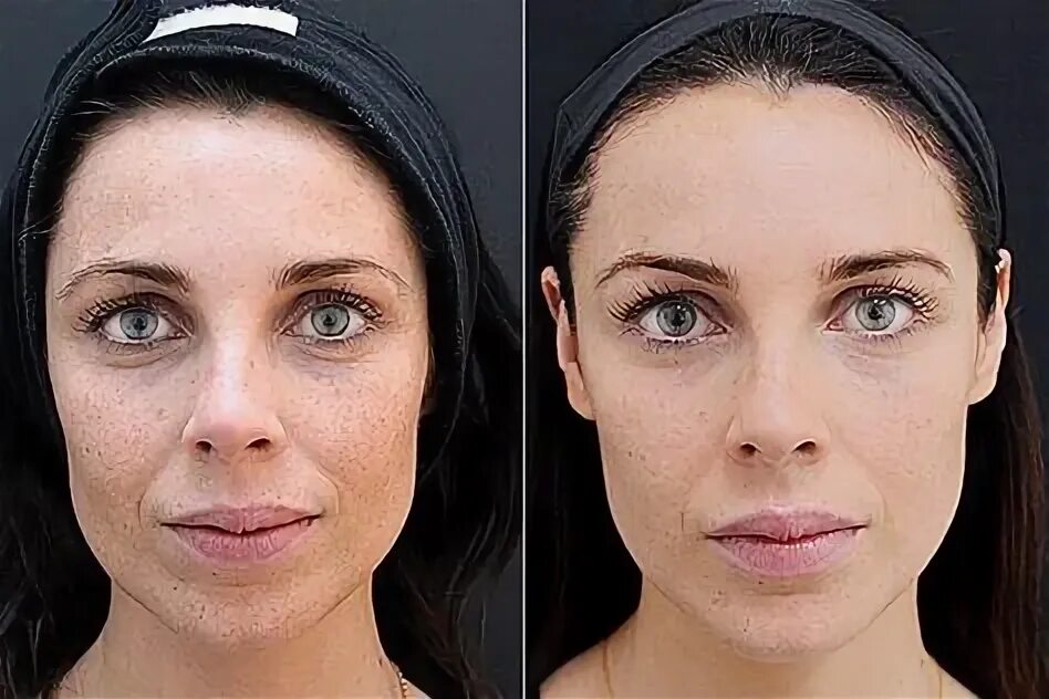 Филлеры и ботокс в чем разница. Ботокс худое лицо. ботокс глаза. full face фото до и после.