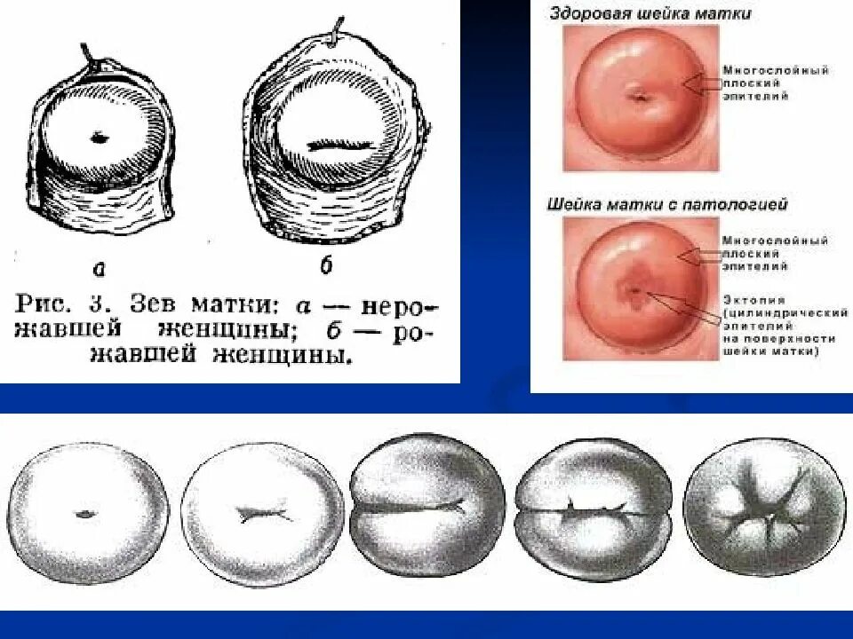 Маточный зев. Коническая форма шейки матки. Форма шейки матки цилиндрическая и кони. Внутренний маточный зев.