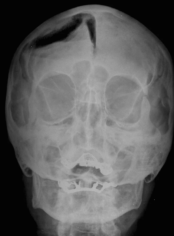 Трещина в голове. Перелом костей основания черепа рентген. Оскольчатый перелом черепа рентген. ЧМТ перелом свода черепа. Оскольчатый перелом затылочной кости.