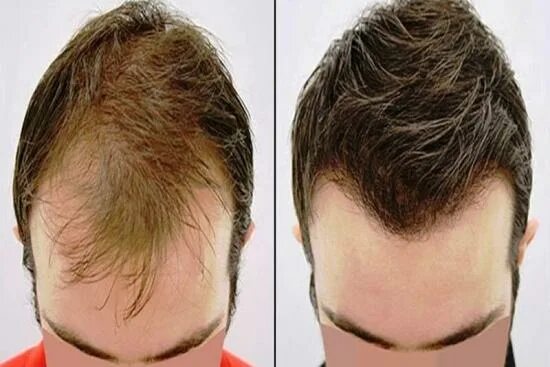 Пересадка волос в Турции. Трансплантация волос в Турции. Пересадка волос у мужчин.