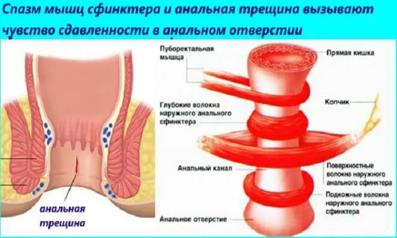 Сфинктерит прямой кишки симптомы. Спазмированная мышца прямой кишки. спазм анального сфинктера.