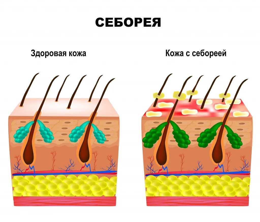 Dandruff in the Hair. Flaky Scalp. Seborrhea Stock Photo - Image of hair, diseas
