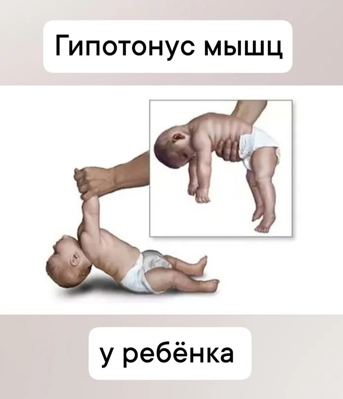 Гипертонус тазовых мышц
