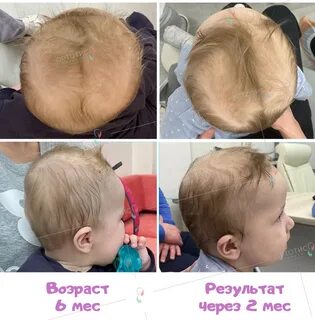 Брахиоцефалия