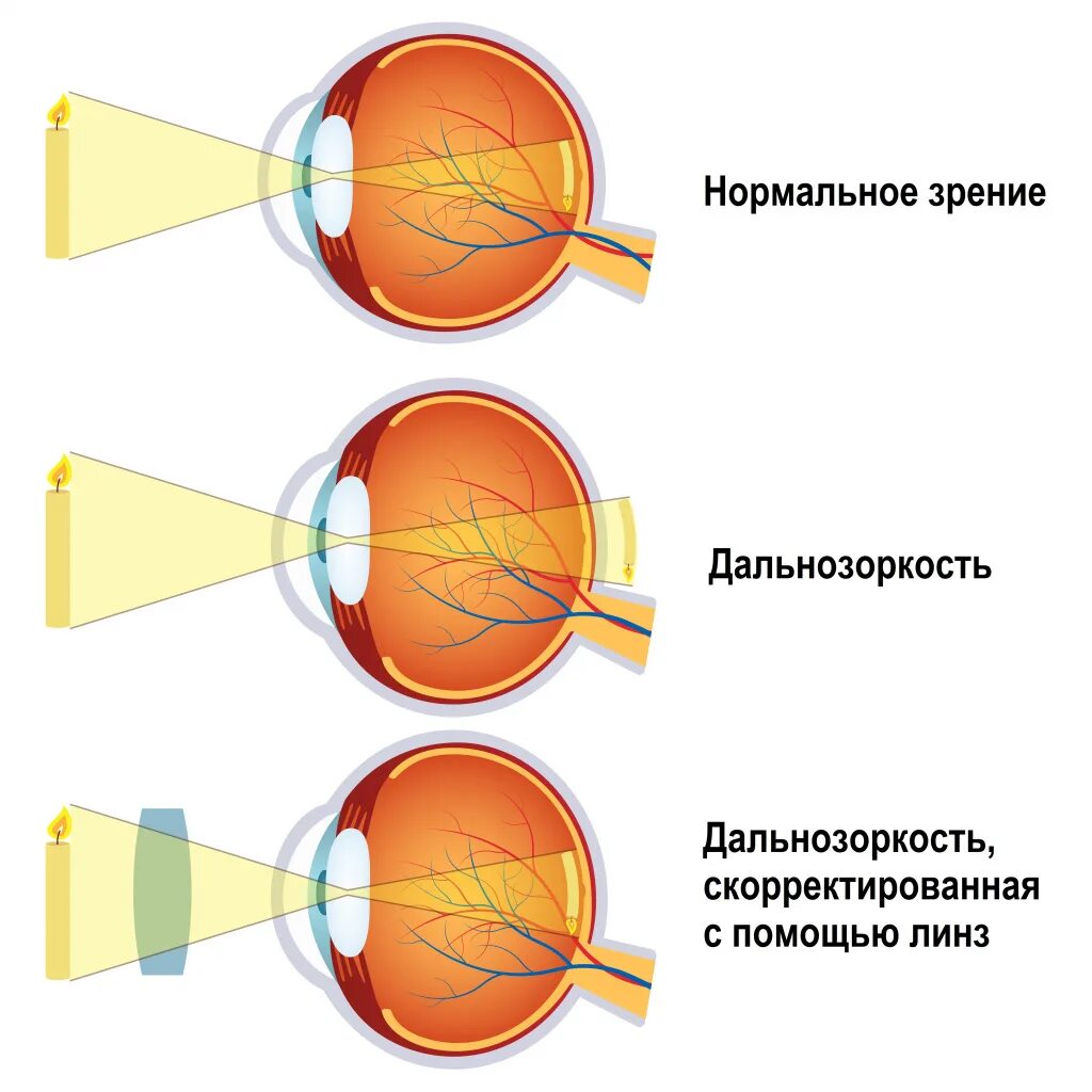 Дальнозоркость. Близорукость и дальнозоркость. Зрение дальнозоркость. Дальнозоркость (гиперметропия). Миша страдает близорукостью а его брат дальнозоркостью