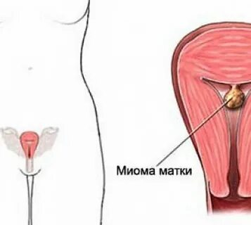 Удаление матки сколько восстановление