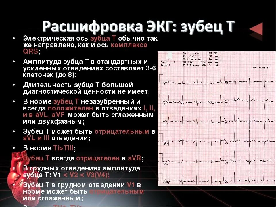 Изменения миокарда предсердий. Расшифровка ЭКГ зубец t. Зубцы q r s t ЭКГ. P/QRS/T ось норма ЭКГ У взрослых. 3 Зубца s в стандартных отведениях ЭКГ.