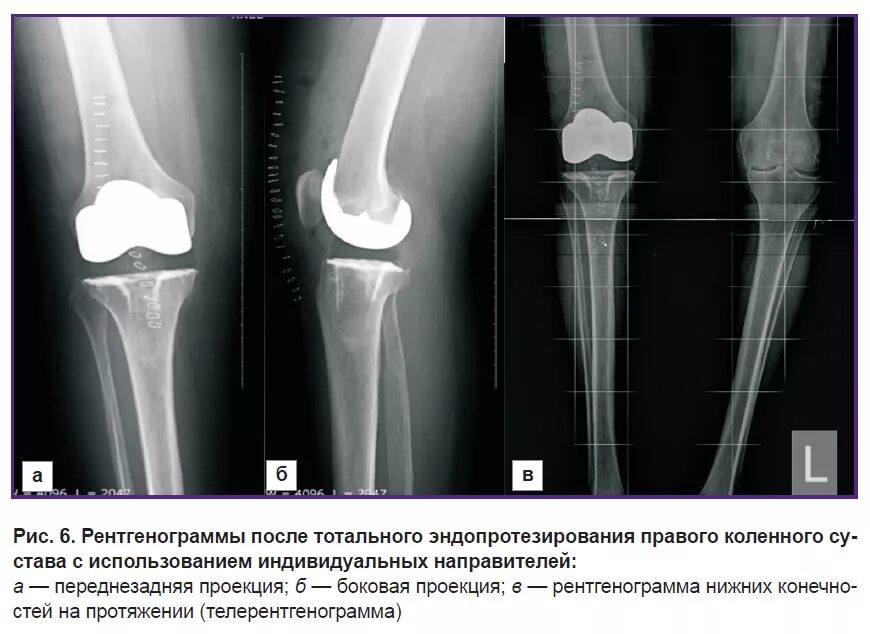 Эндопротезирование коленного сустава клиника. Рентген колена после эндопротезирования. Рентген эндопротеза коленного сустава. Эндопротез коленного сустава рентген. Нестабильность коленного эндопротеза рентген.