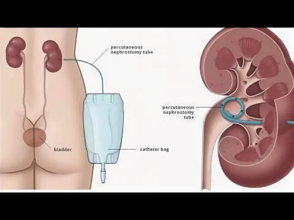 Камень в стенте мочеточника. Урология стент в мочеточнике. Пункционная нефростома. Нефростома чрескожная пункционная. Нефростома катетер.