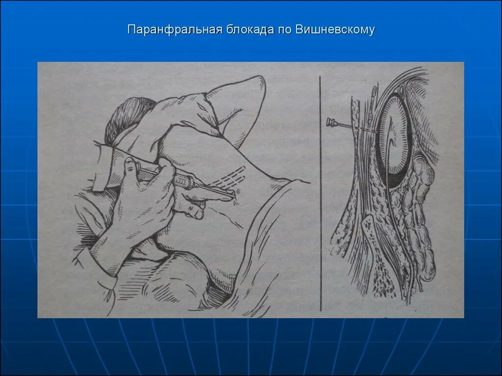 Новокаиновая блокада Вишневского. Паранефральная блокада топографическая анатомия. Новокаиновая блокада Школьникова Селиванова. Шейная вагосимпатическая новокаиновая блокада. Школьникова селиванова