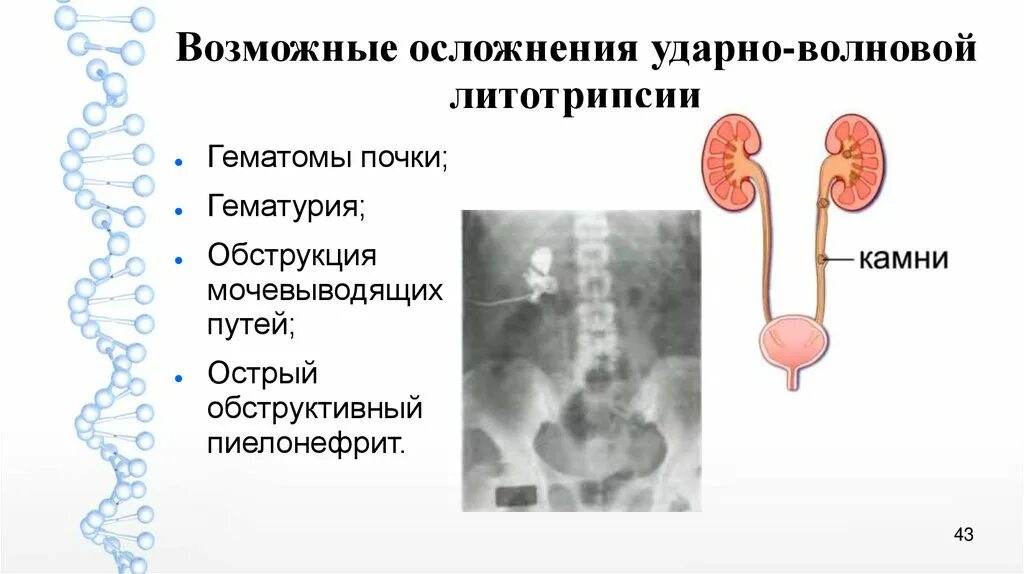 Обструкция мочеточника. Обструкция нижних мочевых путей. Обструкция мочевого тракта. Обструкция мочевыводящих путей. Обструкция верхних мочевыводящих путей.