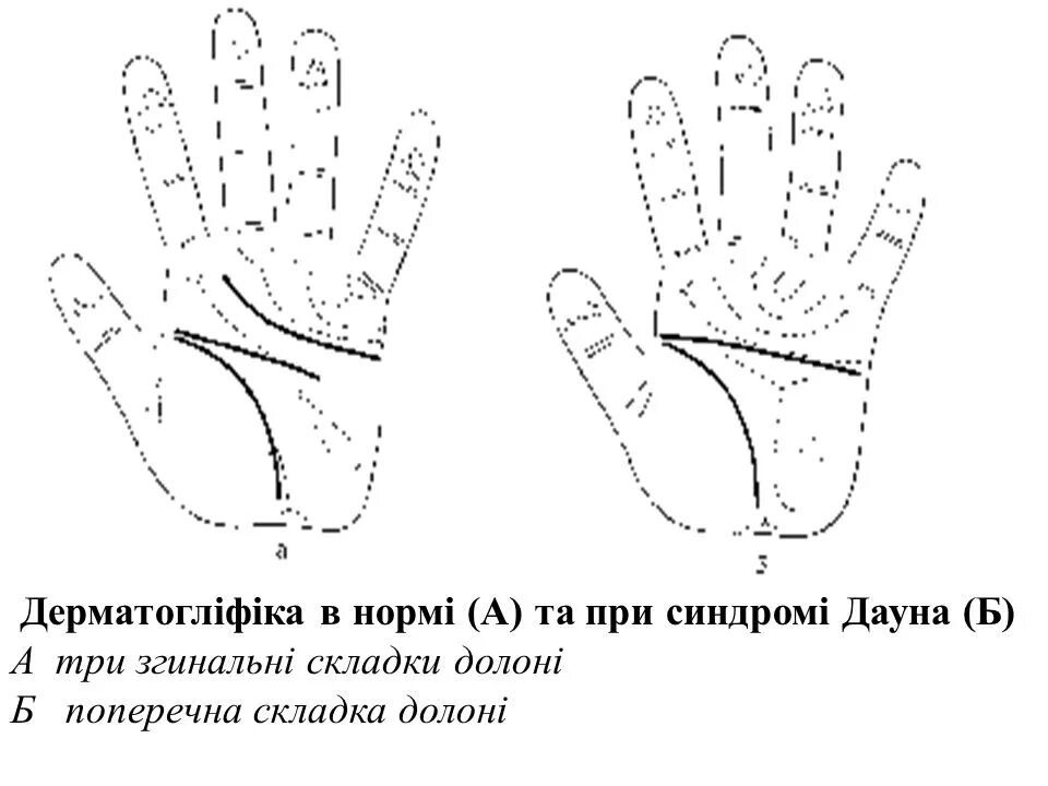 Обезьянья линия на ладонях синдром Дауна. Ладонь человека с болезнью Дауна. Рука дауна