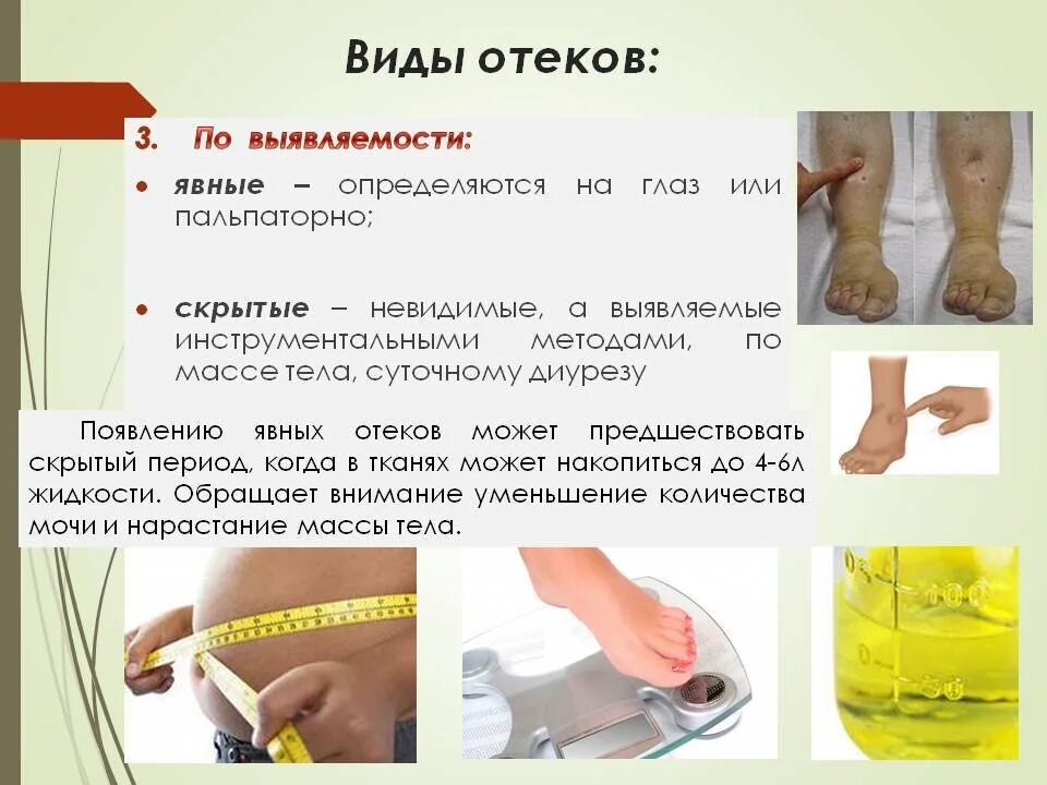 Методы выявления скрытых отеков. Методы определения скрытых отеков. Выявление отеков у пациента. Течет вода из ноги