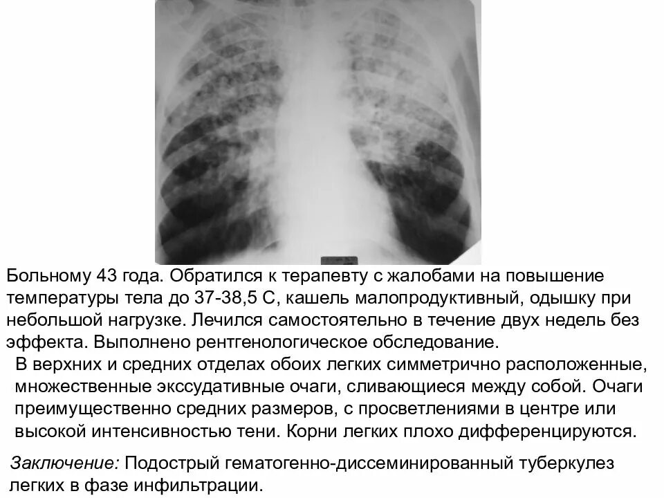 Туберкулез легких в фазе инфильтрации. Диссеминированный туберкулез в фазе инфильтрации. Милиарный туберкулез фаза инфильтрации. Подострый диссеминированный туберкулез рентген. Диссеминированный туберкулёз лёгких рентген.