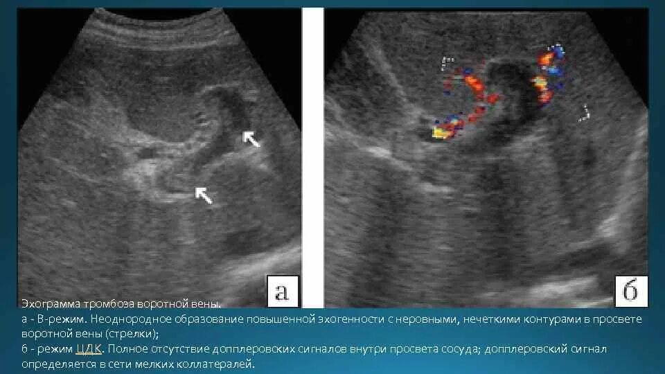 Печень эхогенность неоднородная. Артериовенозная мальформация на УЗИ. Тромбоз почечной вены УЗИ. Портальная Вена печени на УЗИ. Расширение воротной вены на УЗИ.
