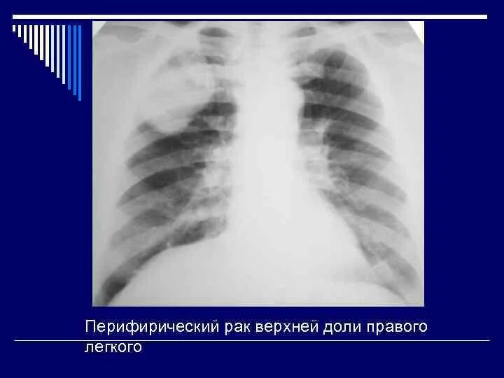 Образование верхней доли правого легкого. Образование в верхней доле правого легкого. Крупное образование в легком. Очаговые образования в легких. Образование верхней доли левого легкого