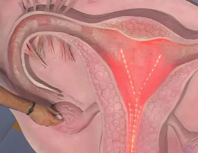 Fibroid - YouTube