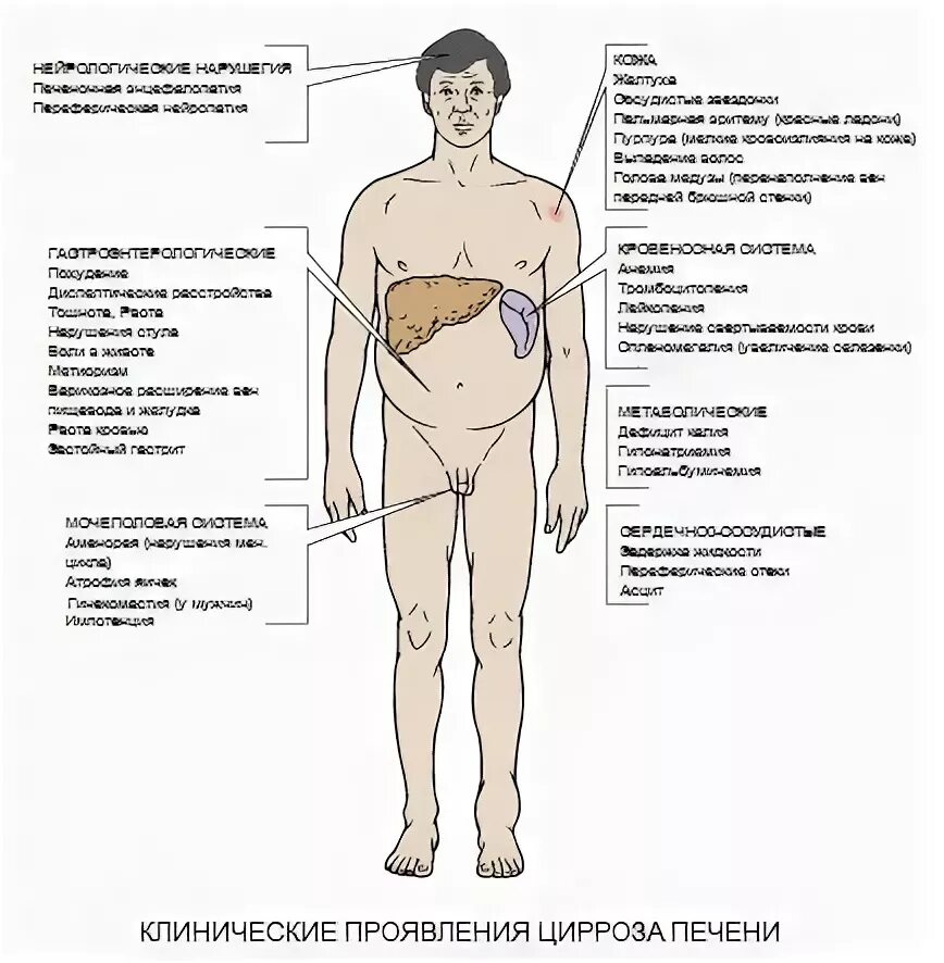 Цирроз первые признаки у женщин. Ранние признаки цирроза печени. Признаки начинающего цирроза печени. Внешние проявления болезни печени. Внешние симптомы цирроза печени.