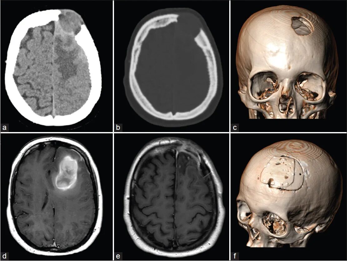 Гистиоцитоз костей черепа. Эозинофильная гранулема костей черепа на кт. Остеома костей черепа кт. Остеосаркома костей черепа кт. Опухоли лобной части