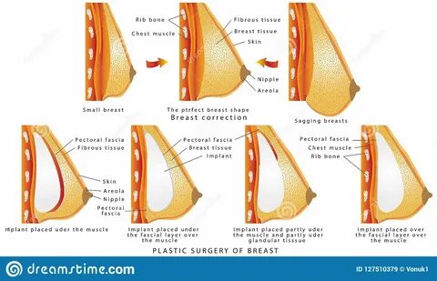 Plastic surgery of breast. 