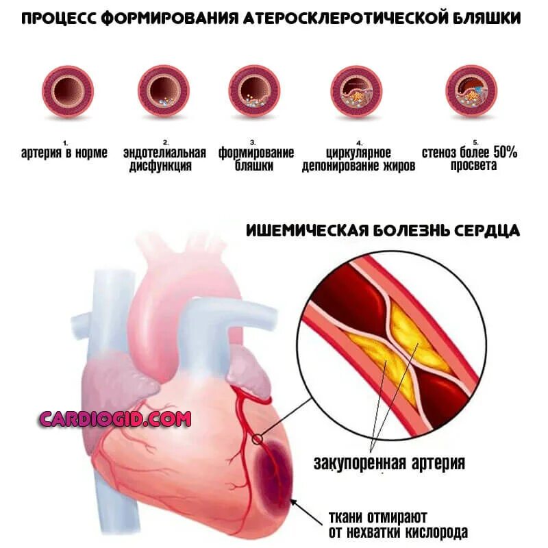 Болит стент. Ишемическая болезнь сердца стадия 5 степени. Степени атеросклероза венечных артерий. Атеросклероз ИБС стенокардия инфаркт. Атеросклероз коронарных артерий симптомы.