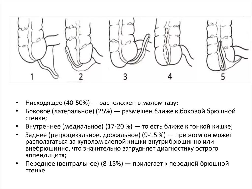 Аппендикс червеобразный. Локализация червеобразного отростка. Острый аппендицит расположение. Виды локализации червеобразного отростка. Червеобразный отросток анатомия расположение.