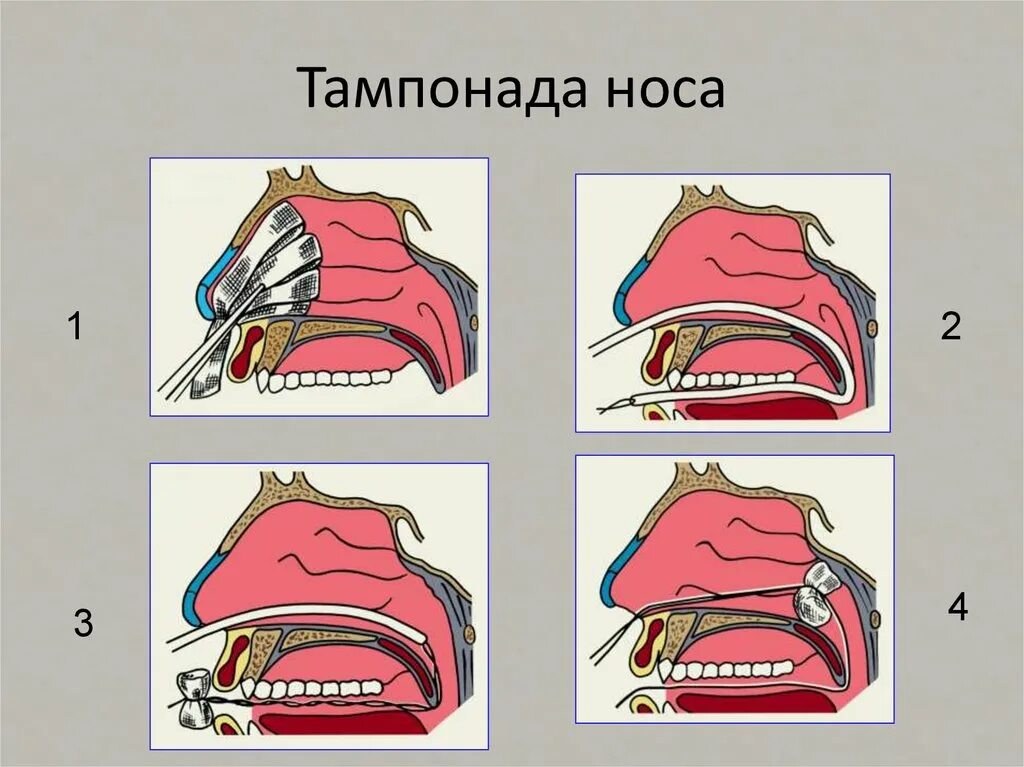 Тампонада раны при кровотечении. Задняя тампонада при носовом кровотечении алгоритм. Передняя и задняя тампонада носа алгоритм. Тампонада носового кровотечения. Носовые кровотечения задняя тампонада.