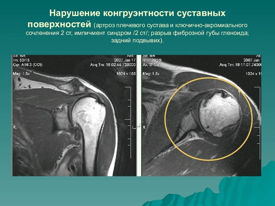 Подвывих плечевого сустава мрт. Повреждение связок плечевого сустава мрт. Импиджмент синдром плечевого сустава кт. Подвывих плечевого сустава кт.