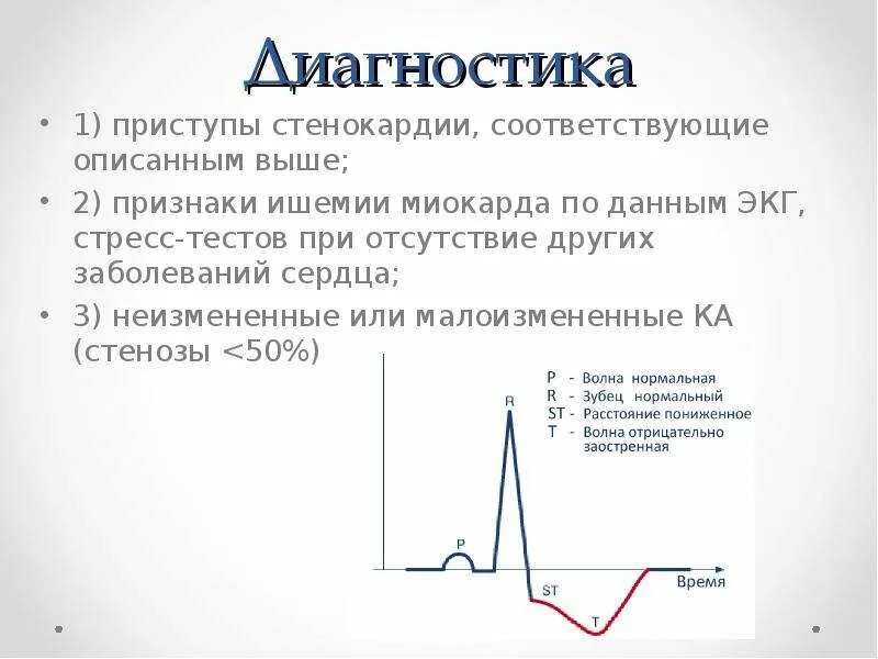 Изменения экг характерные для стенокардии. Экг при стенокардии напряжения. Экг при стенокардии. Признаки стенокардии на экг. Вариантная стенокардия экг.