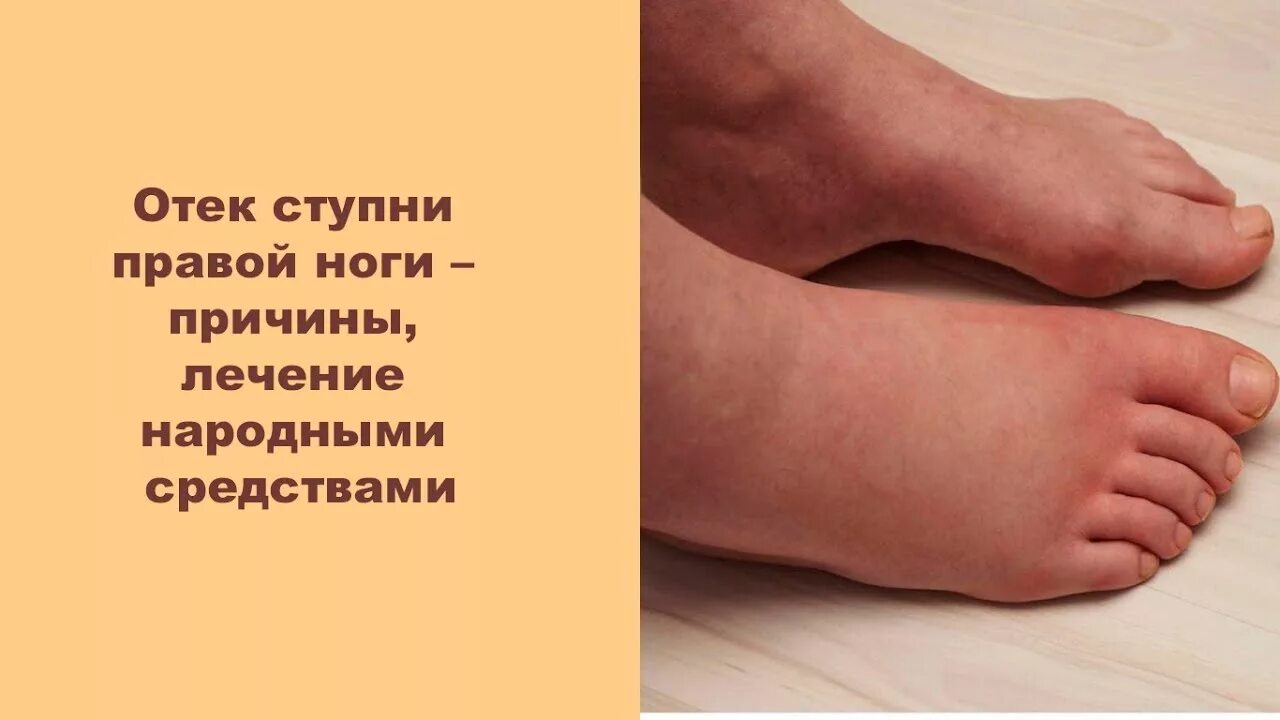 Лечение отеков ступней ног