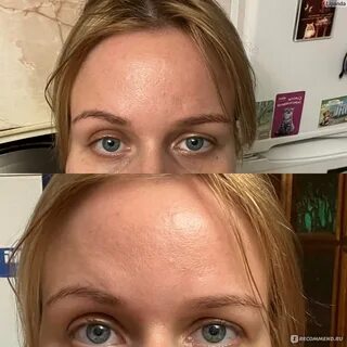 Улыбка ботокс