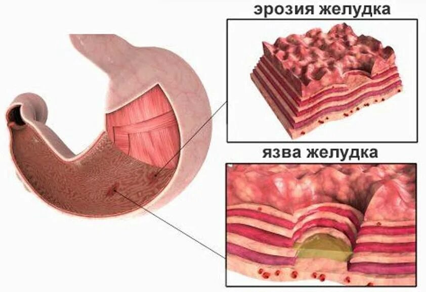 Язвенная болезнь желудка ,эпителизация. Эрозивный гастрит желудка. Язвенная эрозия желудка. Как быстро вылечить язву