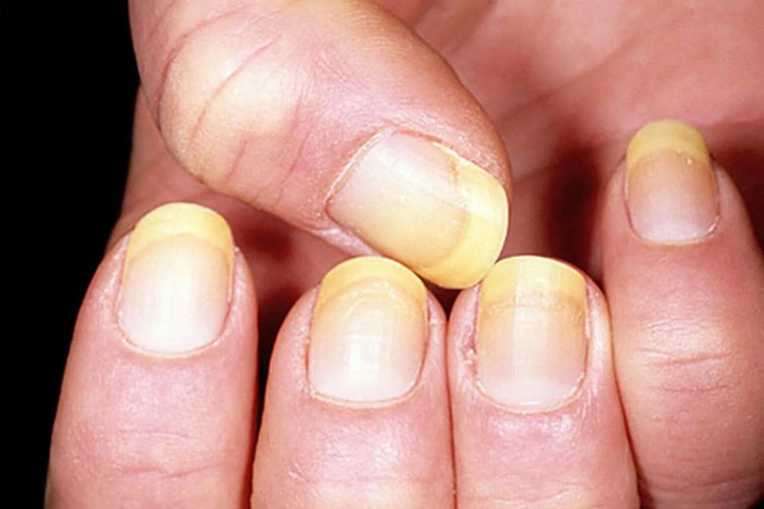 Лечение полос на ногтях. Гиперкератотический онихомикоз. Дерматофиты грибок ногтей. Грибок ногтейтна руках.