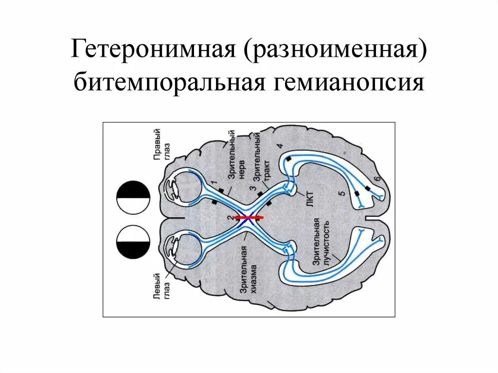 Монимен. Причина развития битемпоральной гемианопсии. Битемпоральная гетеронимная гемианопсия. Гетеронимная битемпоральная гемианопсия причины. Гетеронимная биназальная гемианопсия возникает при поражении.