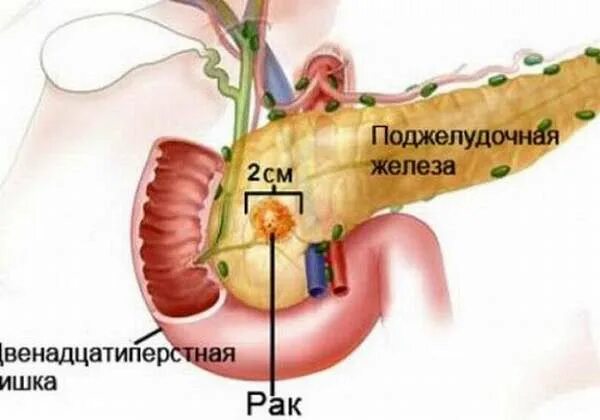 Поджелудочная маркеры. Раковая опухоль поджелудочной железы. Онкопатологии поджелудочной железы. Новообразование головки поджелудочной железы. Онкология головки поджелудочной железы.