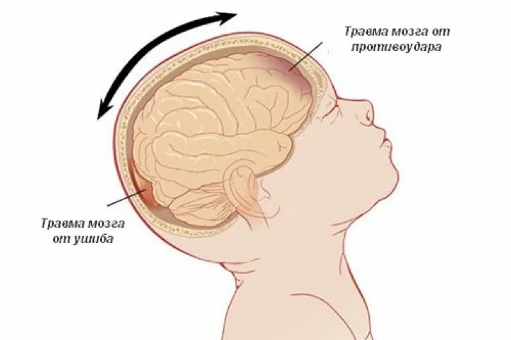 Признак жизни головного мозга. Сотрясение мозга симптомы у детей. Внутричерепная родовая травма новорожденных. Родовая черепно мозговая травма. Синдром встряхнутого ребенка.