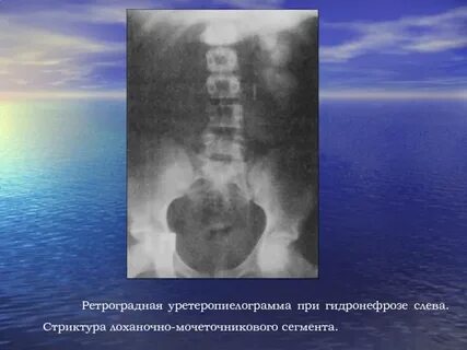 Стриктура мочеточника мкб 10
