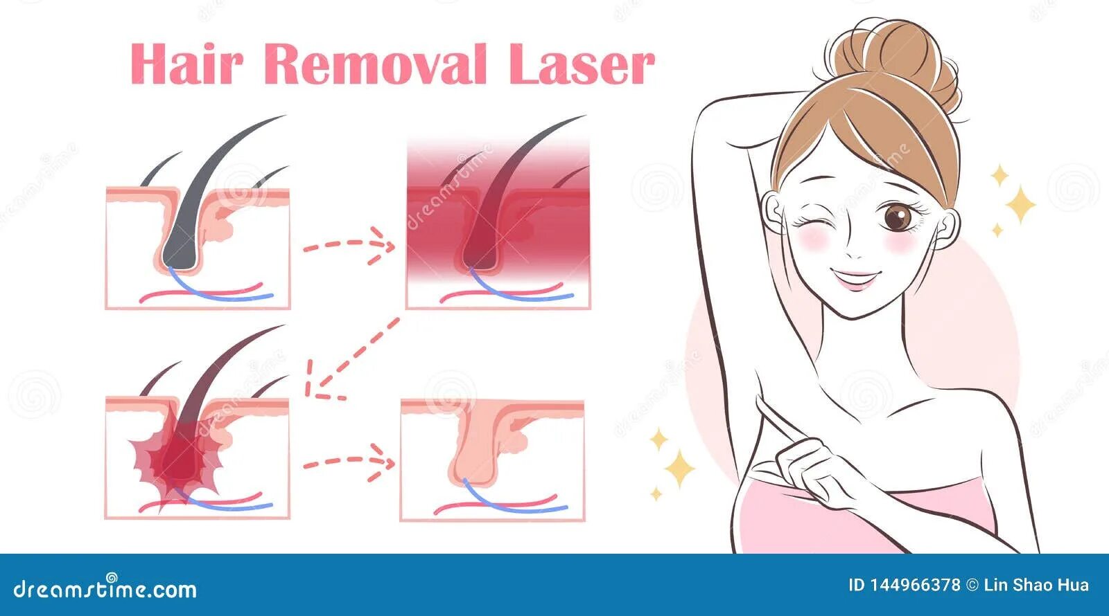 Сонник выдергивать волосы. Значок быстро удаляет волосы. laser hair removal vector. значок быстро удаляет волосы без фона.