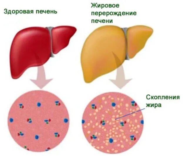 Жировая печень что пить. Гепатоз ожирение печени. Жировая дистрофия печени(жировой гепатоз). Токсический гепатоз печени. Жировое Перерождение печени.