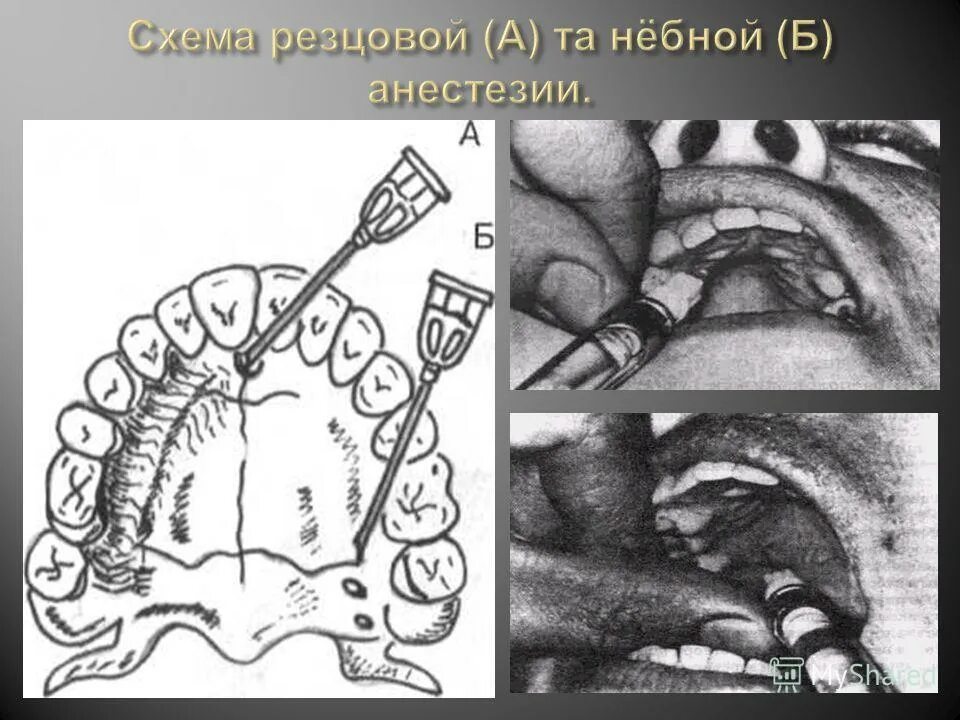Резцовая анестезия в стоматологии зона обезболивания. Небная (палатинальная) анестезия. Небная анестезия методика проведения. Большая небная анестезия. Большая небная анестезия.