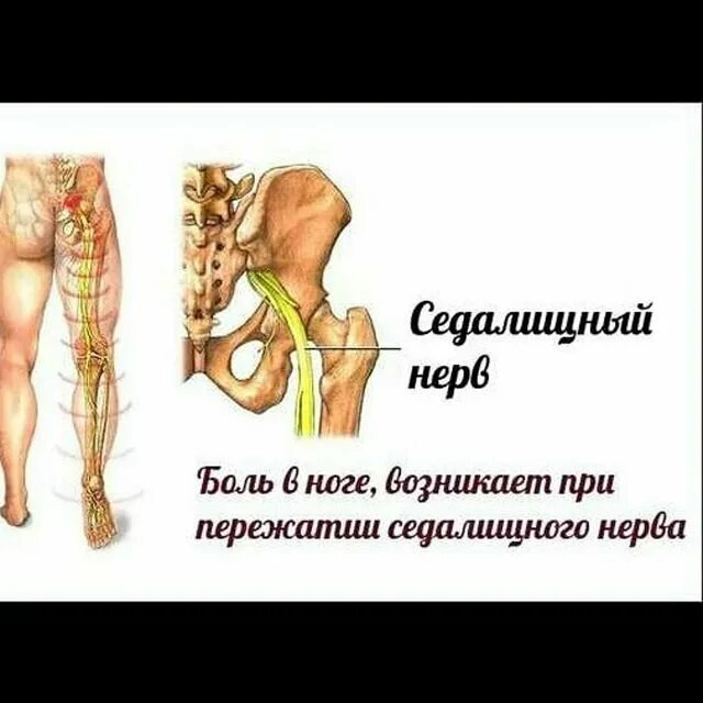 Воспаление нерва в ноге симптомы и лечение. Реабилитация при неврите седалищного нерва. Реабилитация при неврите седалищного нерва. Как лечить седалищный нерв. Поражение седалищного нерва симптомы.