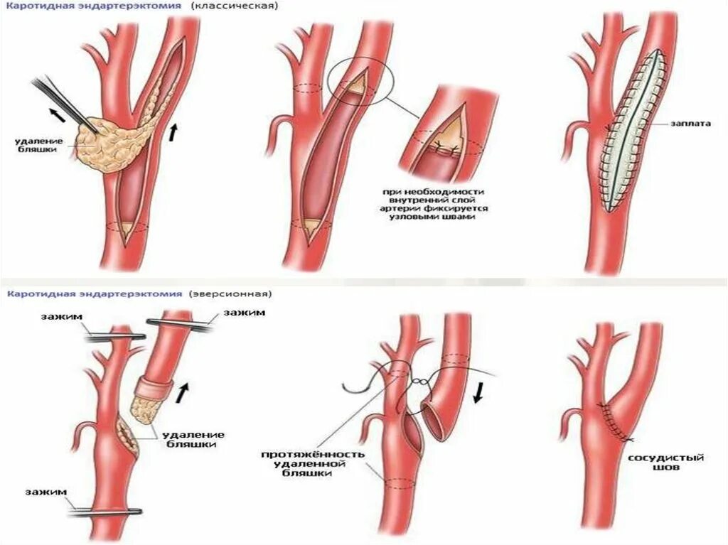 Эндартерэктомия это. Каротидная эндартерэктомия сонной артерии ход операции. Инверсионная каротидная эндартерэктомия что это такое. Эверсионная эндартерэктомия. Каротидная эндартерэктомия этапы.