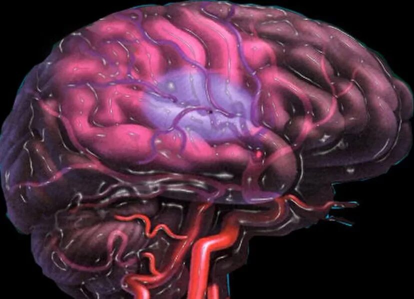 Нарушение мозгового кровообращения инсульт. Ишемические нарушения мозгового кровообращения. Сосудистая патология головного мозга. ОНМК мозг. Болезни сосудов головы