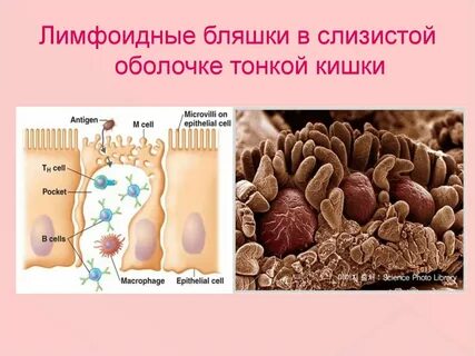 Бляшки кишечника