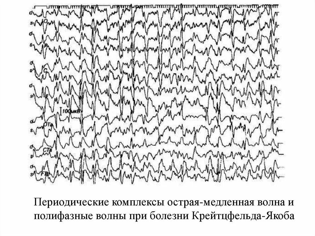 Комплекс острая волна медленная волна на ЭЭГ. Полифазные потенциалы на ЭЭГ. Полифазные потенциалы на ЭЭГ У детей. Комплекс пик волна острая медленная. Медленные волны на ээг