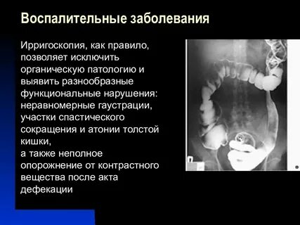 Ирригоскопия это